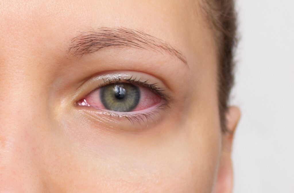 A close up of a woman with a red, dry eye.