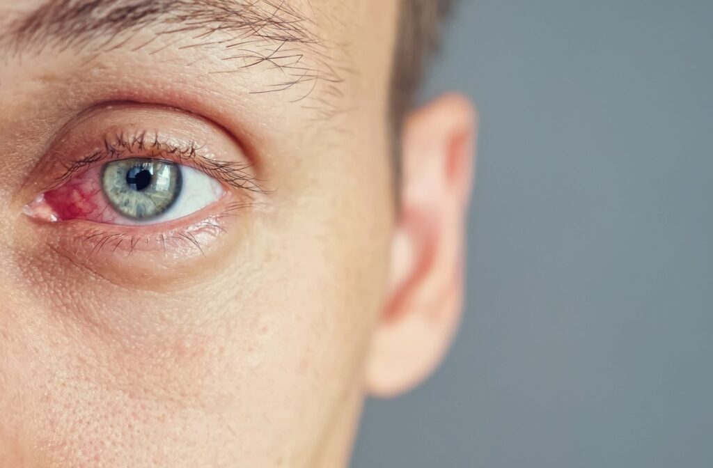 A close up of a woman's dry eye.