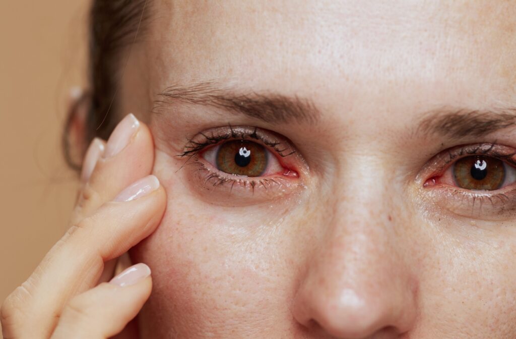 A close-up of a person's red, watery, and irritated eyes from dry eyes.